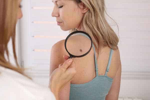 What Are Traditional Skin Lesion Removal Methods Eastcote?