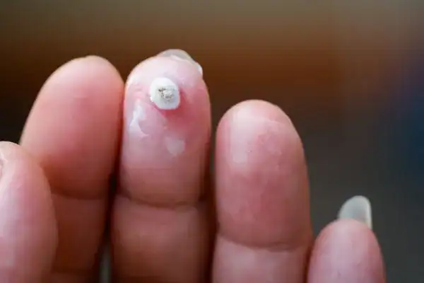 Image of white wart before cryopen treatment Eastcote