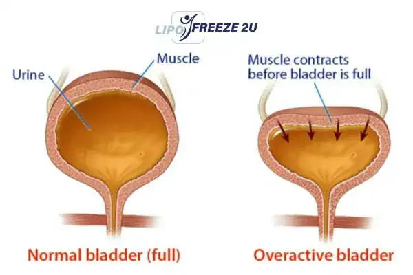 diagram of overactive bladder treatment Eastcote