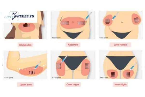 Benefits of Choosing Aqualyx for Fat Reduction Eastcote