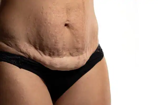 loose skin after weight loss injections Eastcote