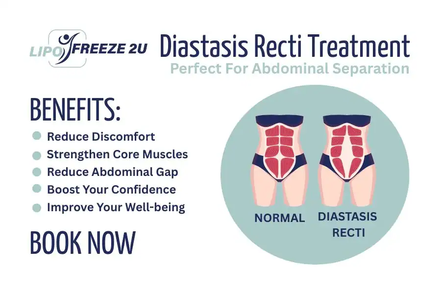 How Long Will It Take to See Improvements in Diastasis Recti Eastcote