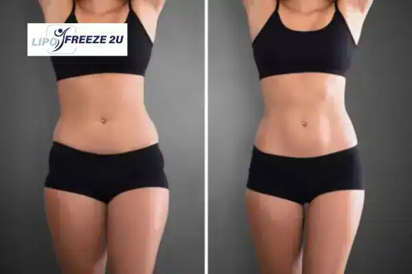 How Can LIPO FREEZE 2U Support Your Post-Pregnancy Body Recovery Eastcote?