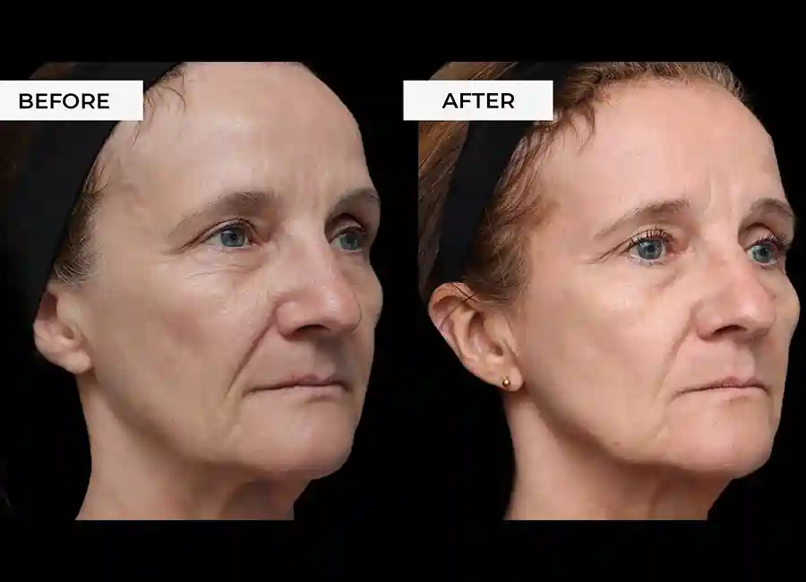 How Many RF Microneedling Sessions Will You Need to See a Difference Eastcote?