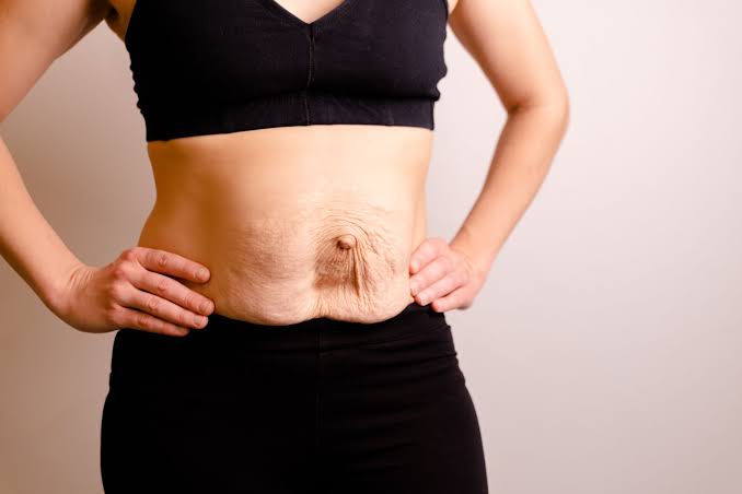 Is Surgery Really the Only Way to Repair Diastasis Recti Eastcote?