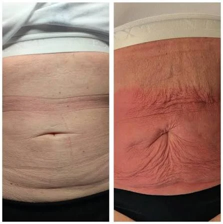 How Does RF Microneedling Improve Crepey, Thin and Uneven Skin Texture Eastcote?
