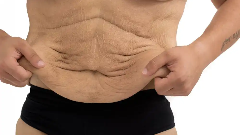 RF Microneedling for Loose Skin: How Can It Help Tighten and Reshape the Skin Eastcote?